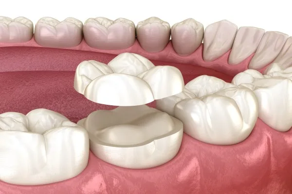 dental-crown-2105