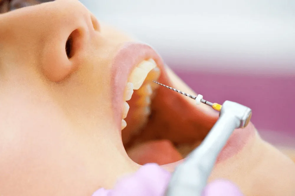 root canal